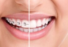„OrthoAligner“ skaidrios ortodontinės kapos dantims tiesinti