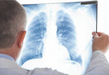 Utenos apskrityje – daugiau nei dvi dešimtys sergančių tuberkulioze