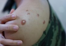 Lietuvoje – pirmasis beždžionių raupų atvejis